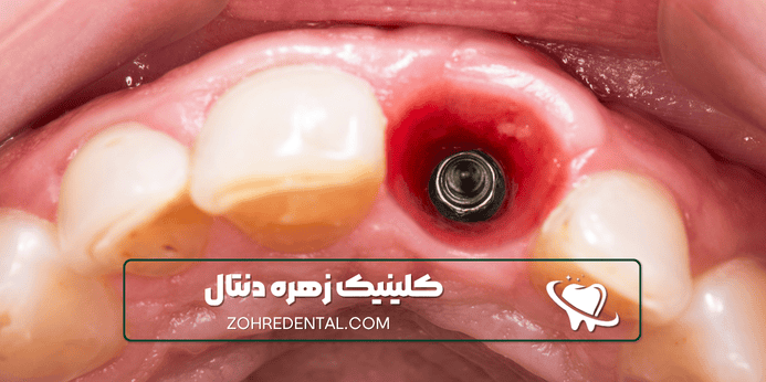 تعرفه ایمپلنت با بیمه آسیا در سال 1404