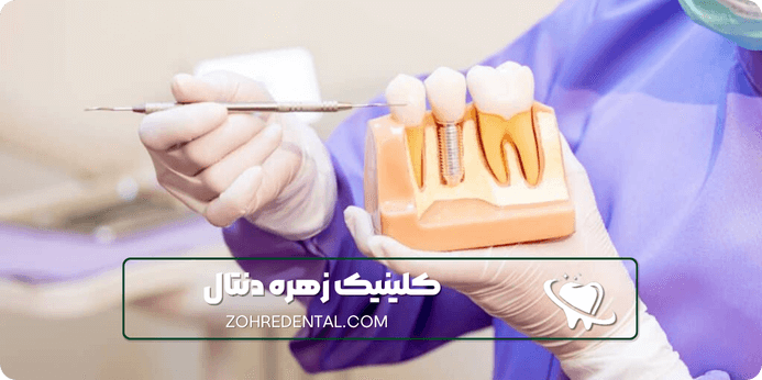 بهترین کلینیک ایمپلنت تهران و ویژگی های آن
