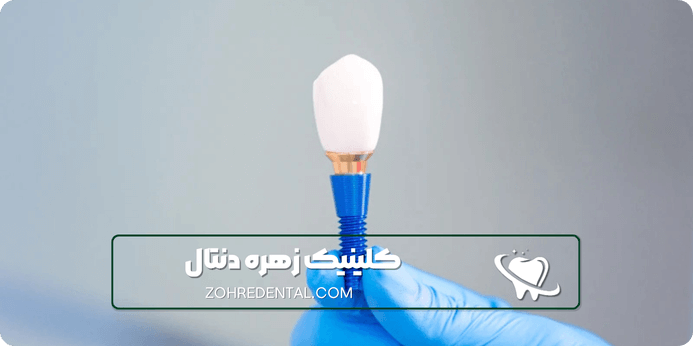 معیار های انتخاب کلینیک ایمپلنت